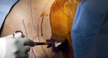 Woman Warns Internet After Friend Allegedly Gets Kidney Stolen While Undergoing Shady Brazilian Butt Lift Surgery Overseas